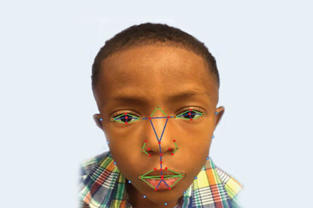 disease-diagnosis-facial-recognition